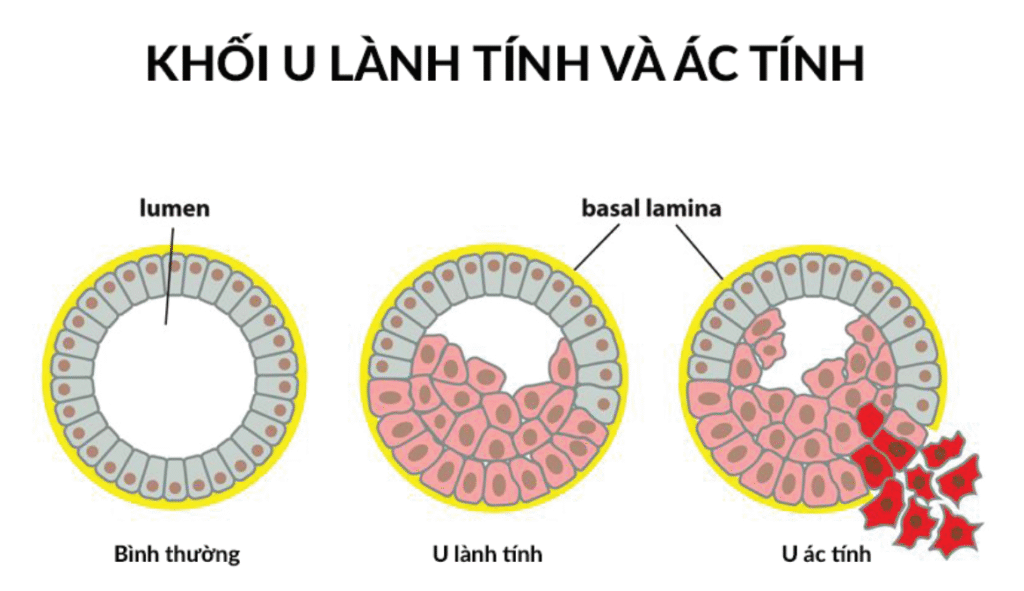 Phân biệt khối u lành tính và u ác tính