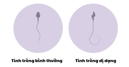 Nhiều người lo lắng tinh trùng dị dạng có thụ thai được không?