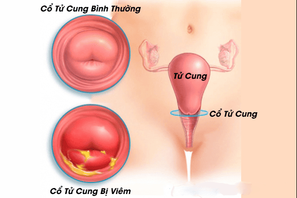 Viêm tử cung làm giảm khả năng mang thai