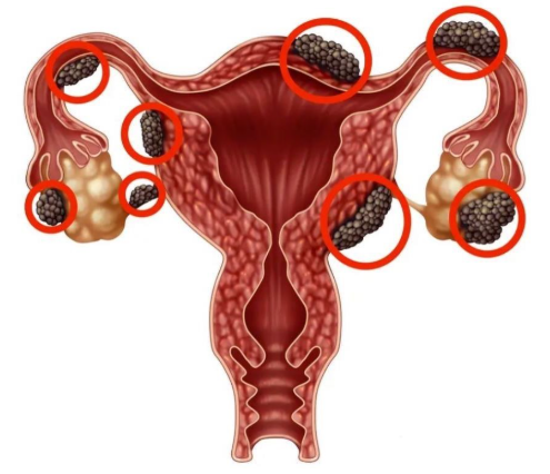 Lạc nội mạc tử cung làm tăng nguy cơ ung thư